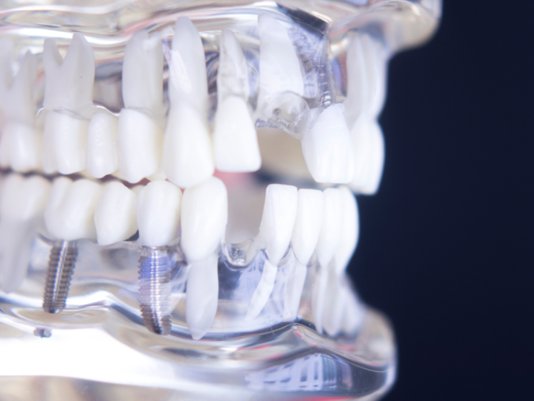 Dental Implants in Noblesville, IN