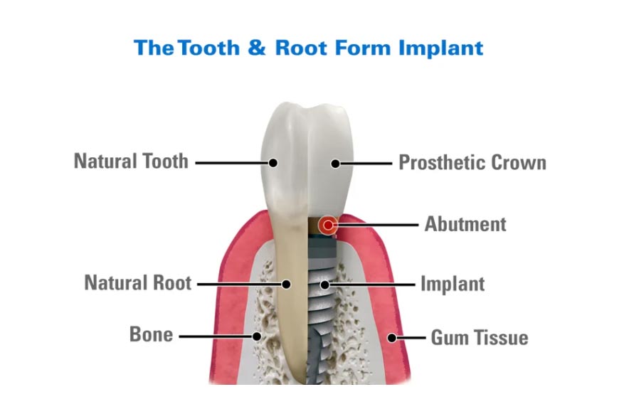 Tooth & Root Form Implant