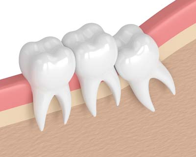 Teeth Extraction Diagram in Noblesville, IN