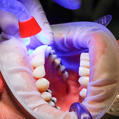 Teeth Whitening in Noblesville, IN